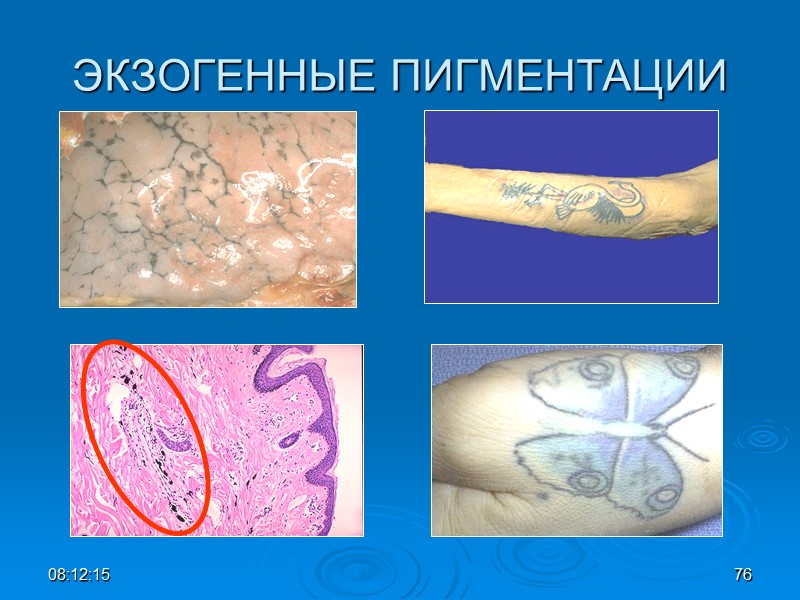 08:12:02 76 ЭКЗОГЕННЫЕ ПИГМЕНТАЦИИ